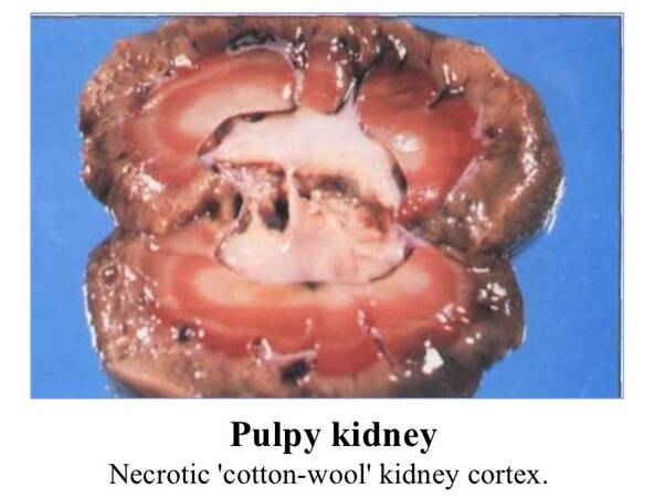 Pulpy Kidney – the one thing you wouldn’t think